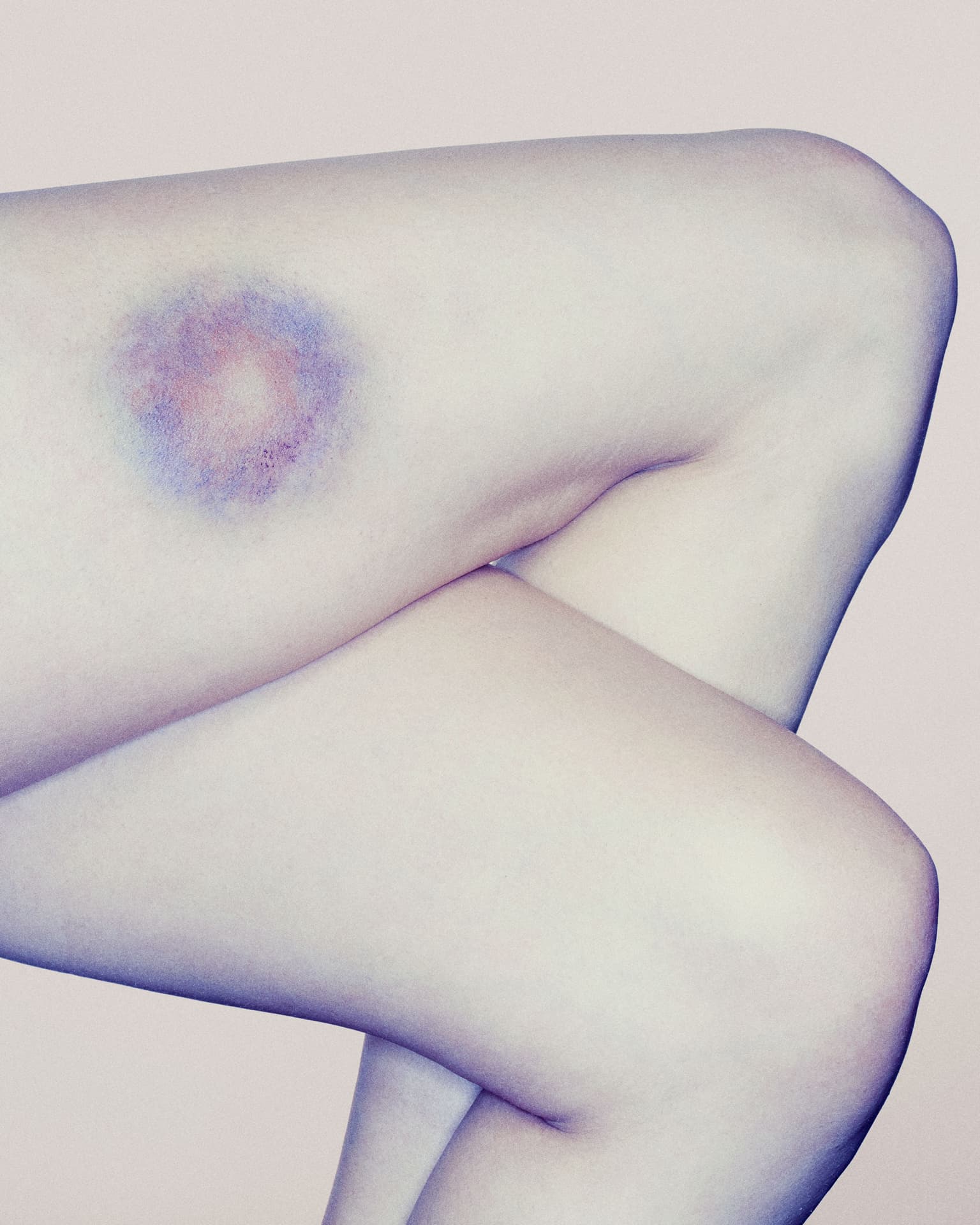 close up of a bruise on a womans leg