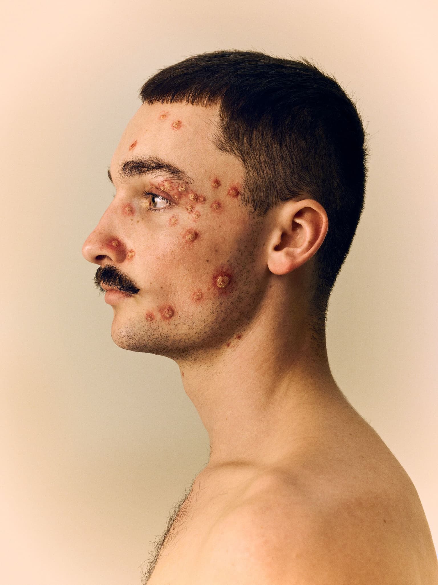 an image of a man with boils on his face