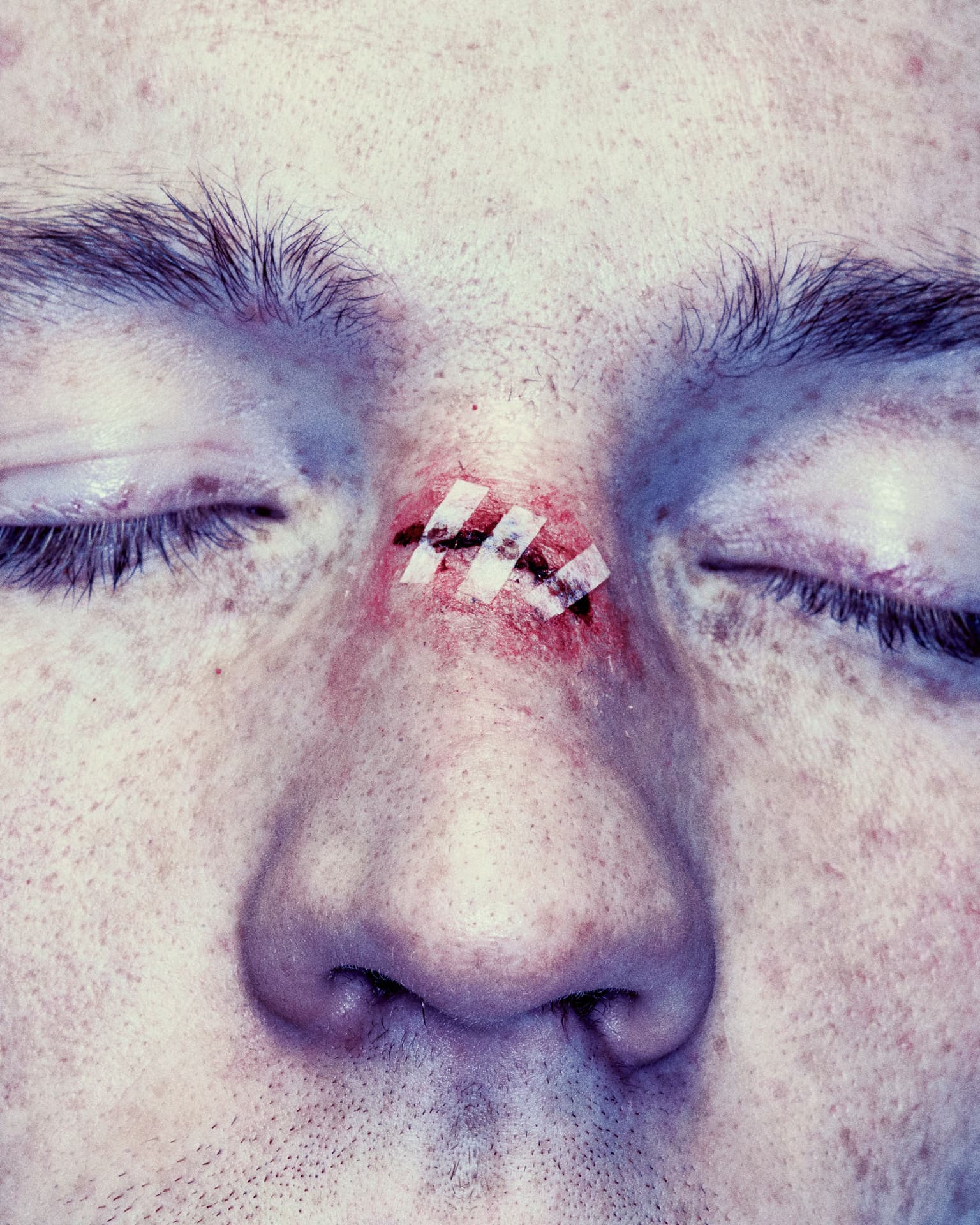 close up of a mans face with a cut on his nose and butterfly strips