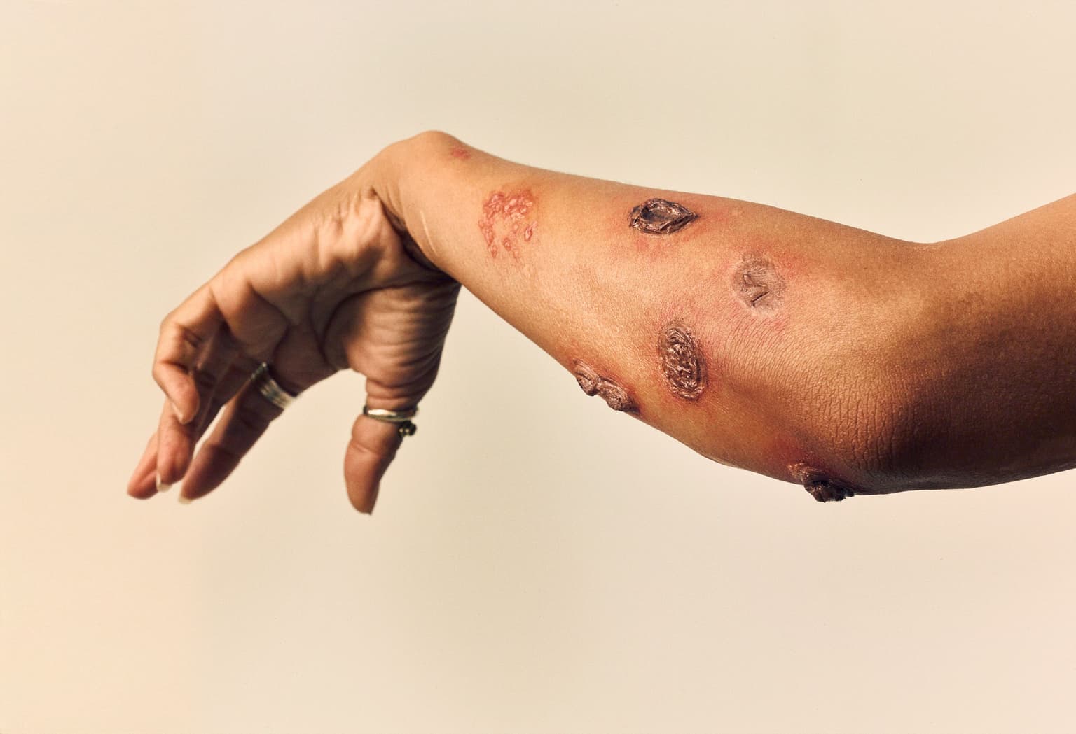 An image of a womans arms with skin disease on it as depicted in sick rose medical illustration book
