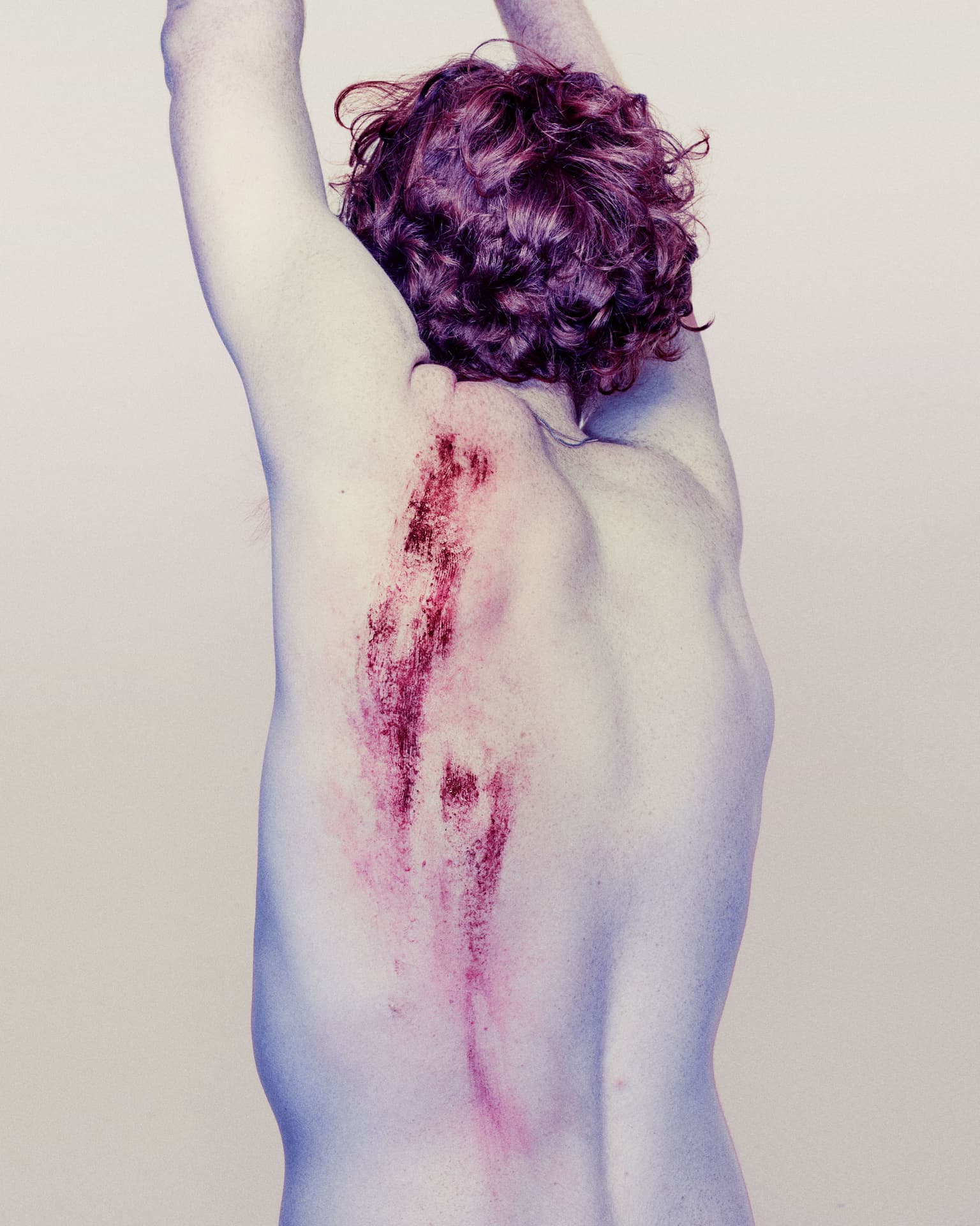 mans back with a big graze on it