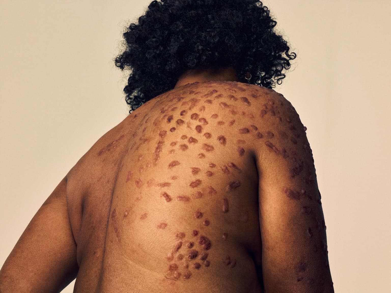 womans back with skin lesions on it