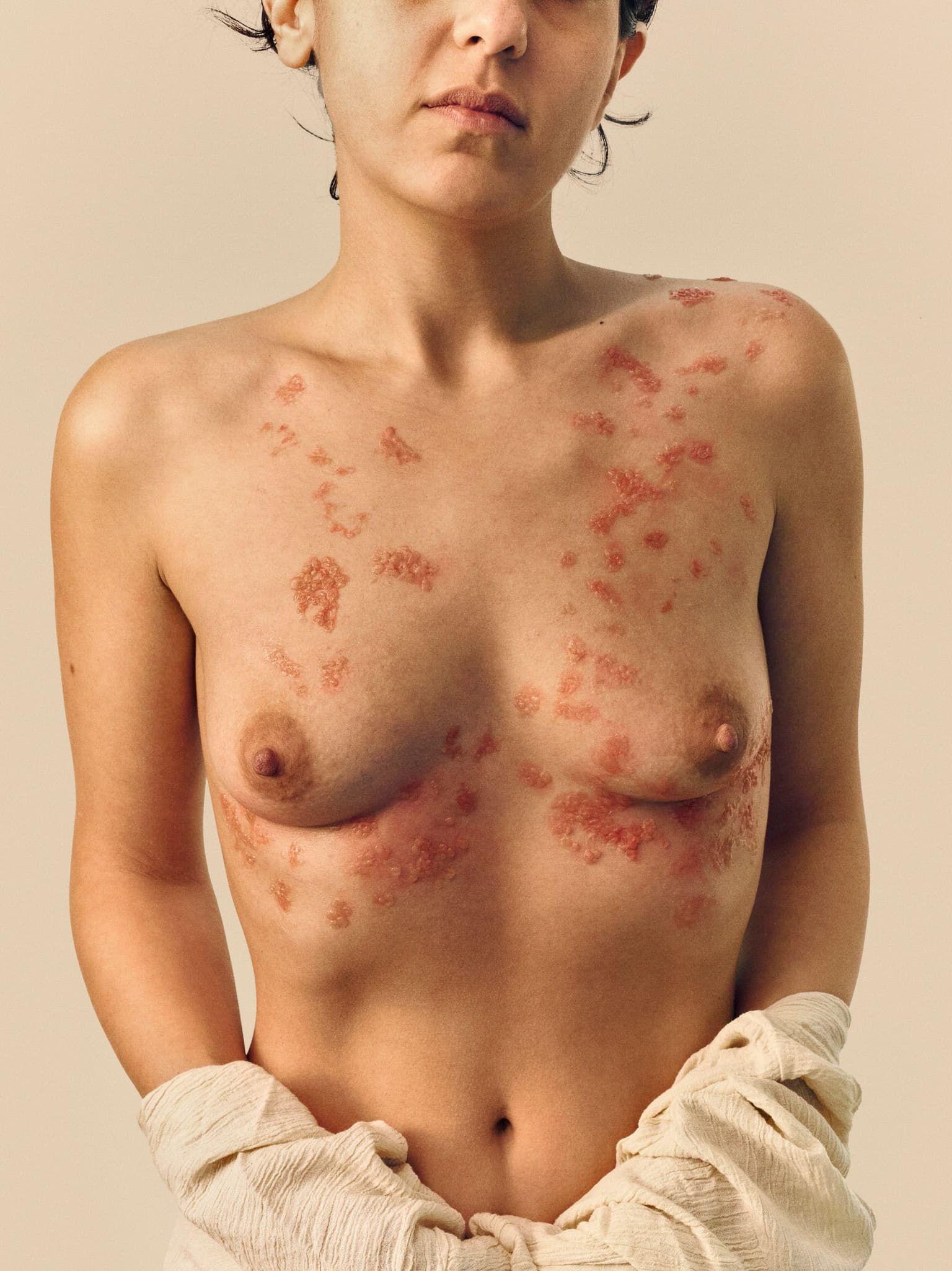 an image of a naked woman with skin disease on her chest
